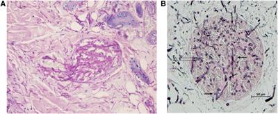 Splenic rupture and fungal endocarditis in a pediatric patient with invasive fusariosis after allogeneic hematopoietic stem cell transplantation for aplastic anemia: A case report